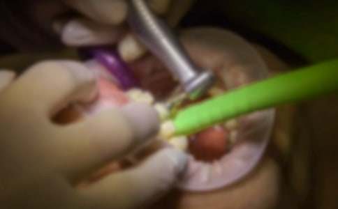 有關(guān)拔牙記的小學(xué)作文