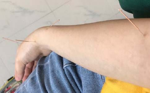 口語對話:我建議你用針灸來治療頭疼